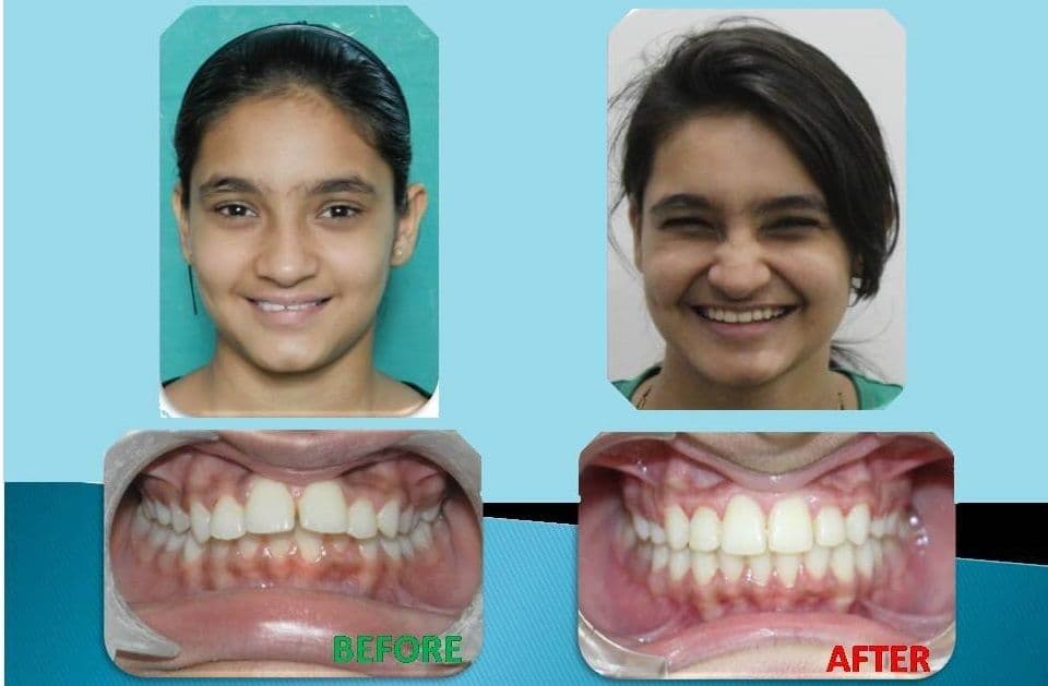 Orthodontic in Pune
