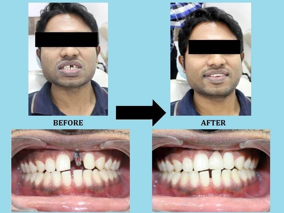 Dental Implant in Pune
