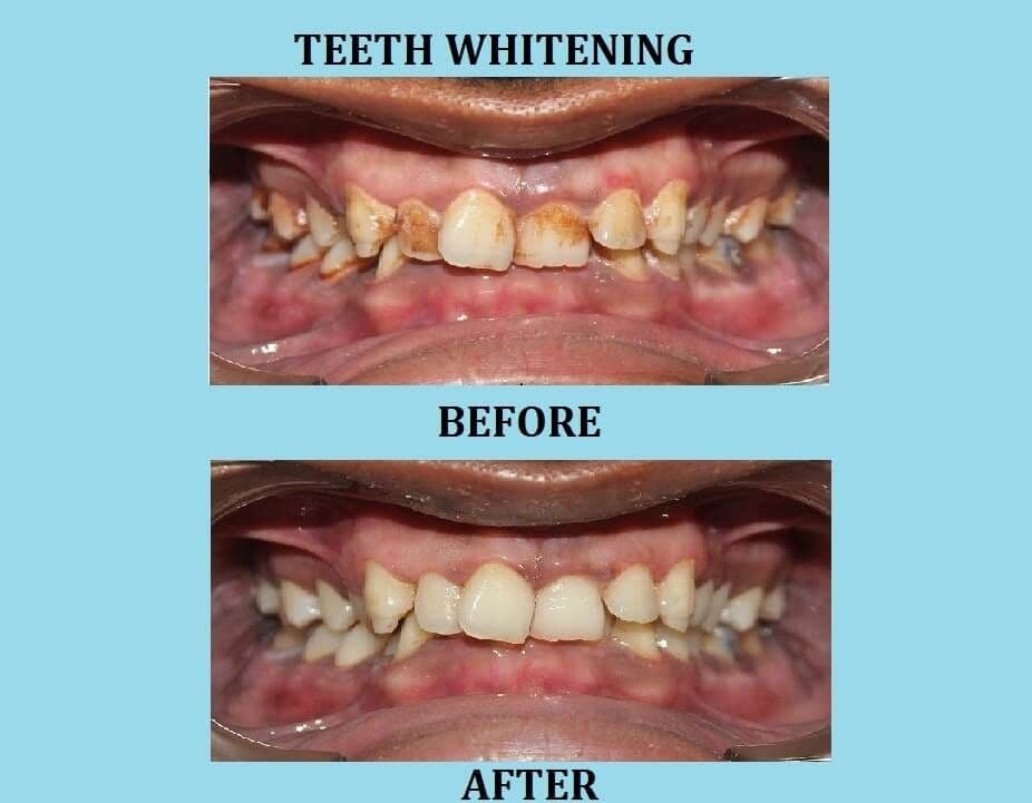 Teeth Whitening in Pune