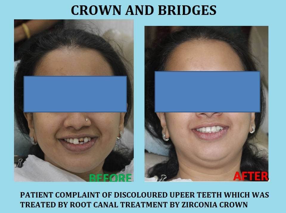 Crown & Bridges in Pune