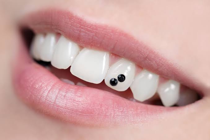 Best Dental Clinic for Tooth Jewellery in Pune