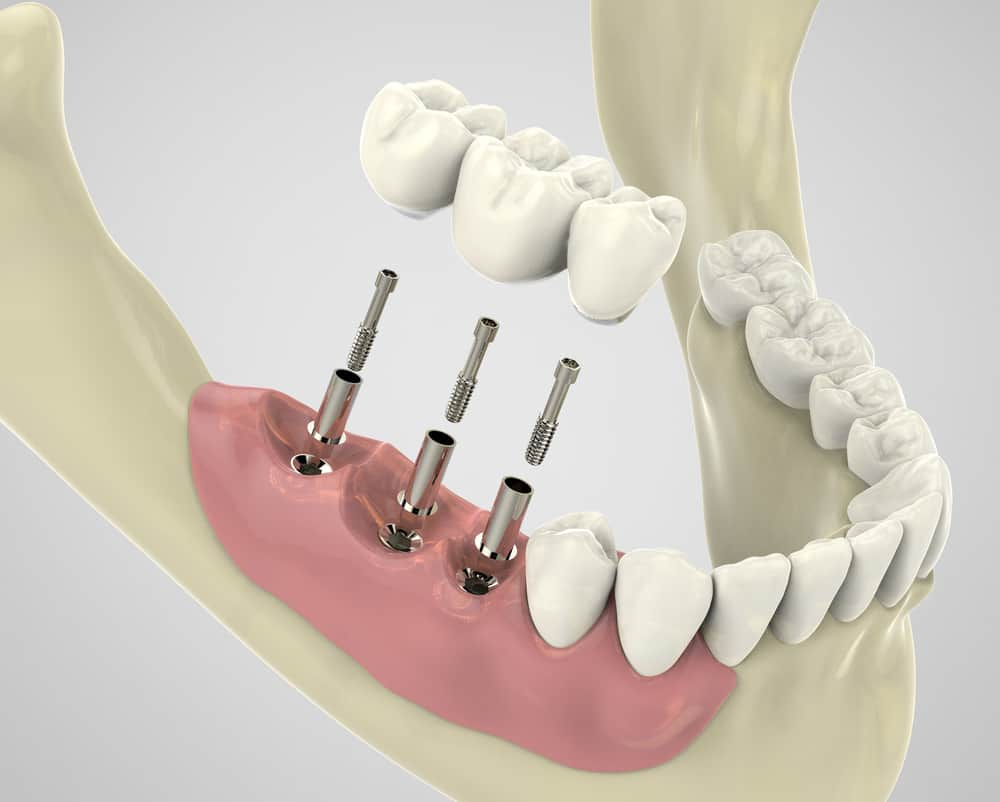 Painless Dental Implants in Pune